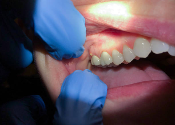Best Emergency Wisdom Teeth Removal in Dixmoor, IL