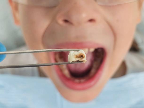 Best Emergency Wisdom Teeth Removal in Dixmoor, IL